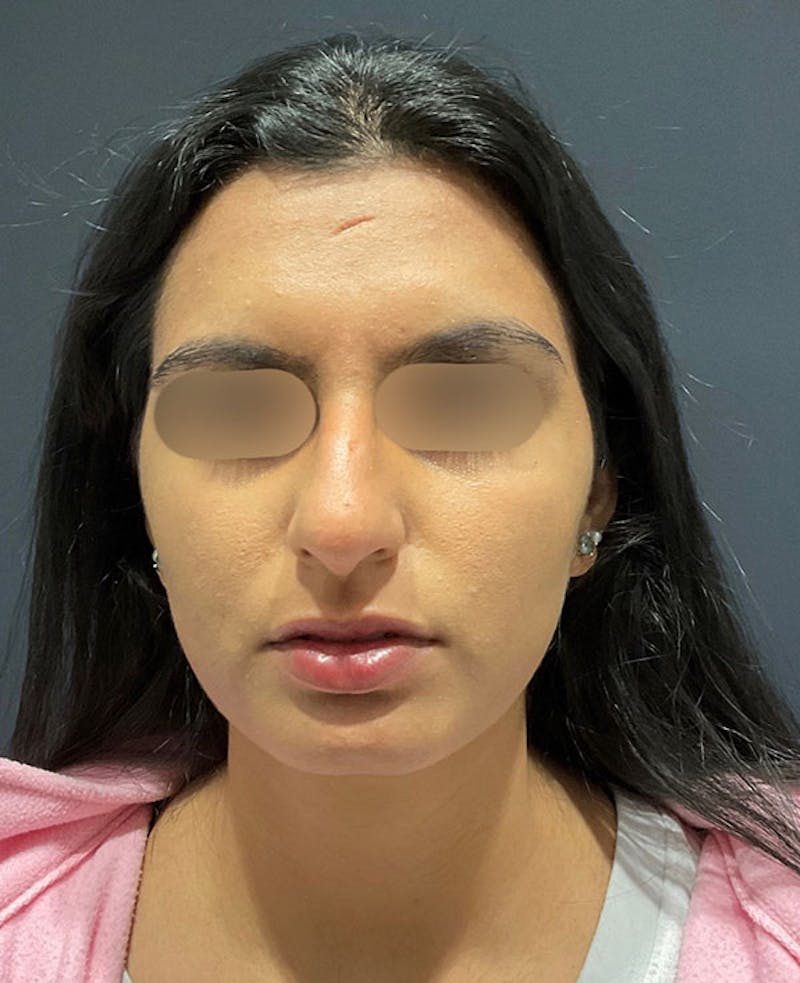 Nose Before & After Gallery - Patient 189960792 - Image 3