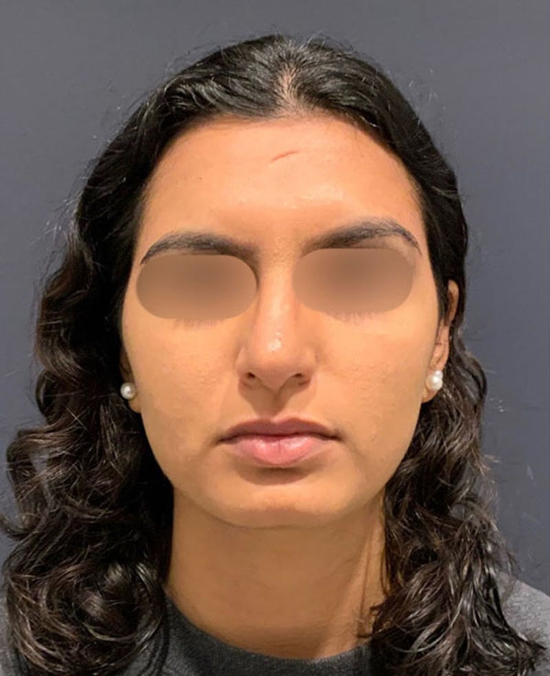 Nose Before & After Gallery - Patient 189960792 - Image 4