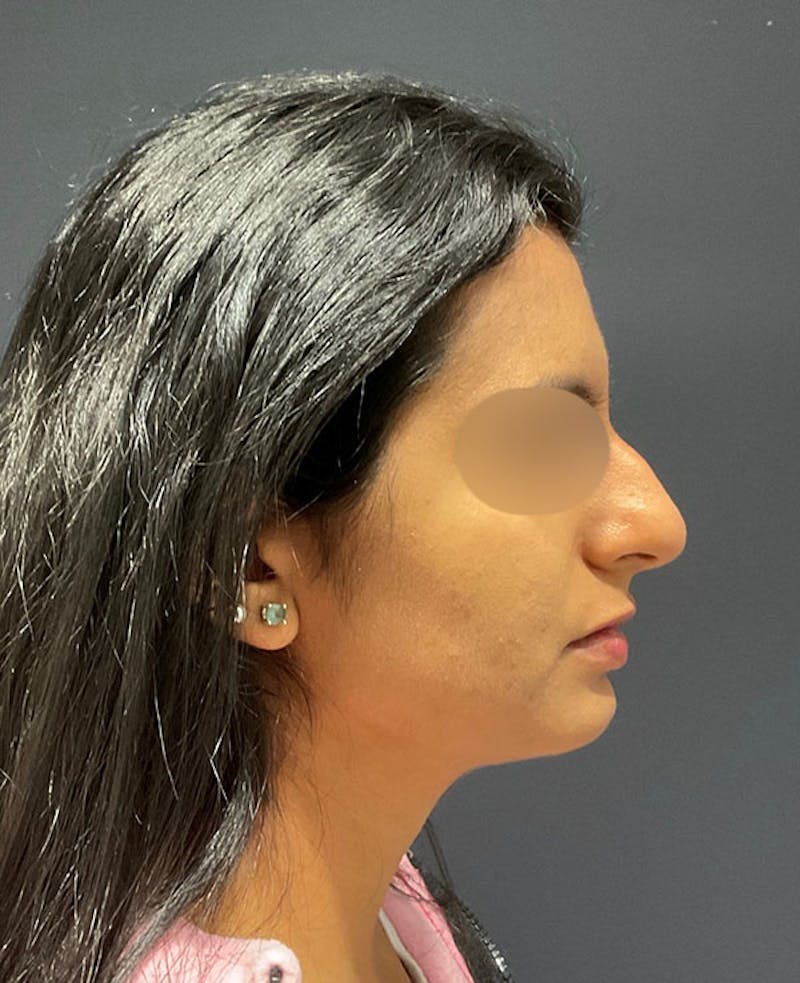Nose Before & After Gallery - Patient 189960792 - Image 1