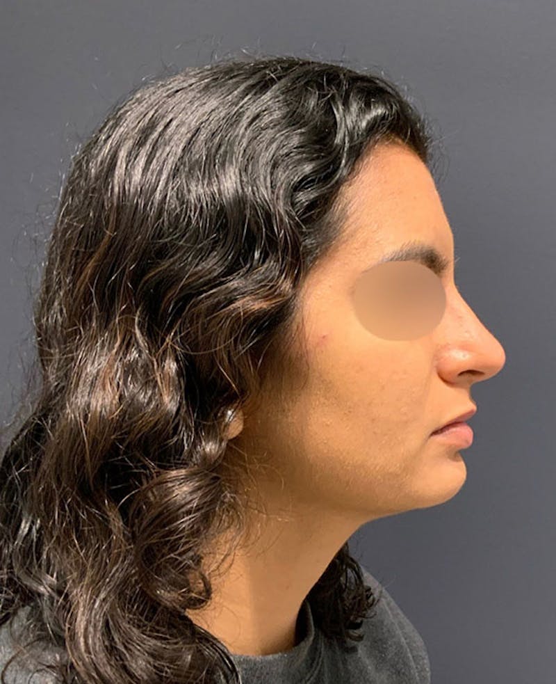 Nose Before & After Gallery - Patient 189960792 - Image 2