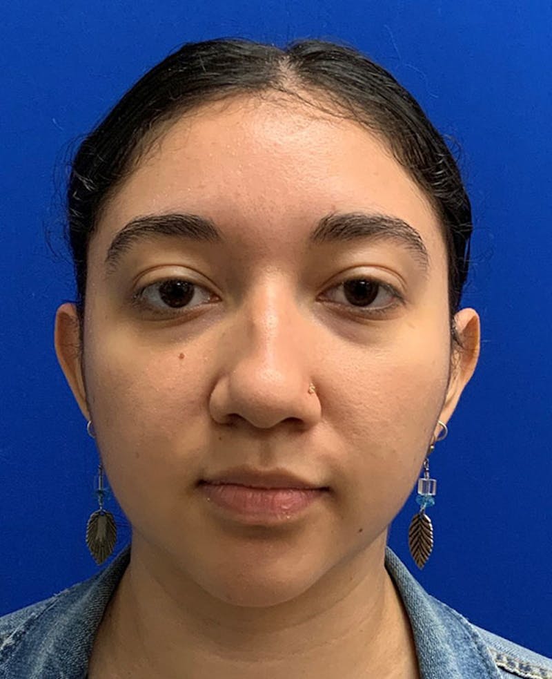 Nose Before & After Gallery - Patient 189960794 - Image 3