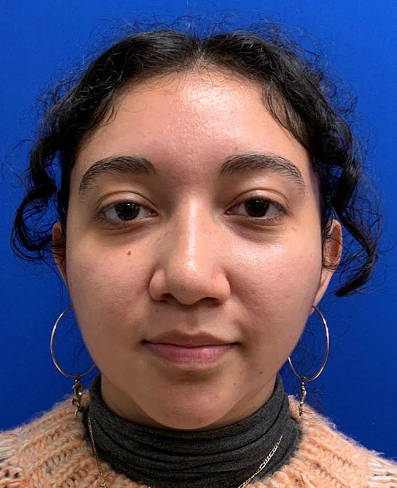 Nose Before & After Gallery - Patient 189960794 - Image 4