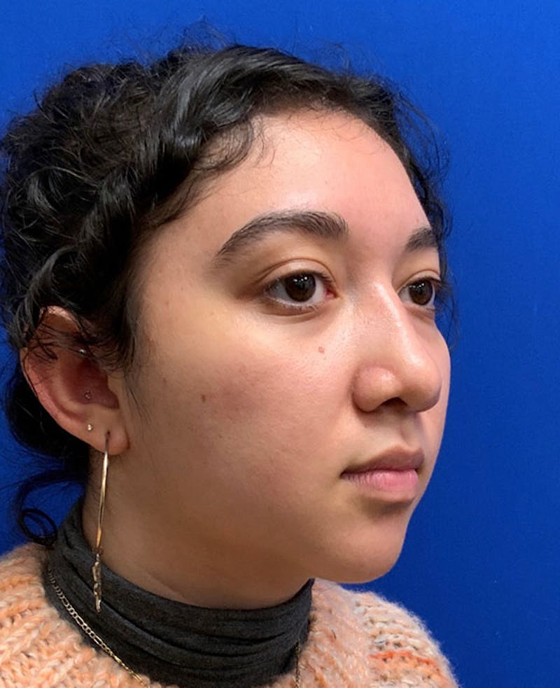 Nose Before & After Gallery - Patient 189960794 - Image 6