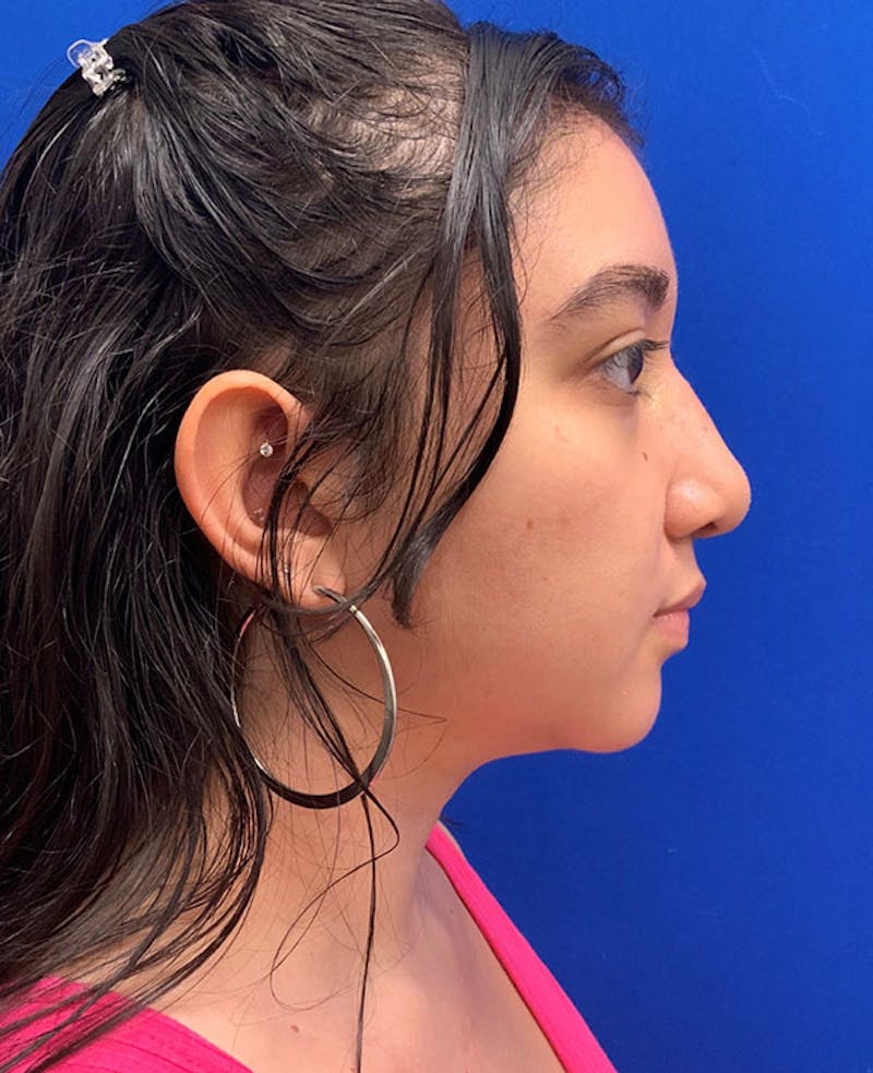 Nose Before & After Gallery - Patient 189960794 - Image 2