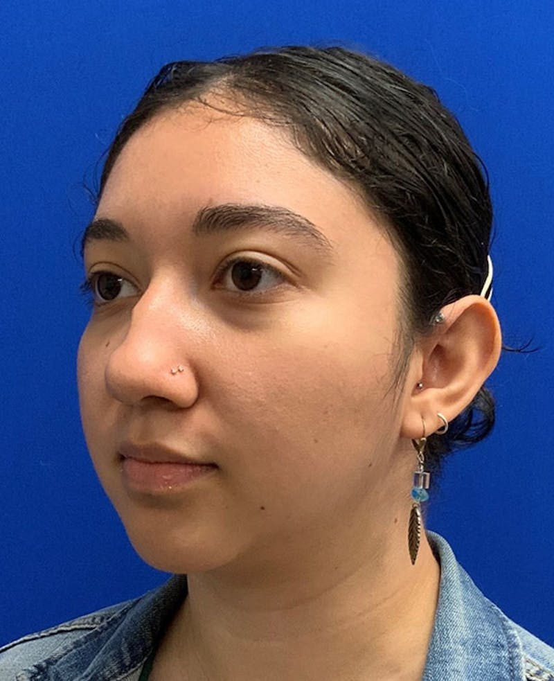 Nose Before & After Gallery - Patient 189960794 - Image 7