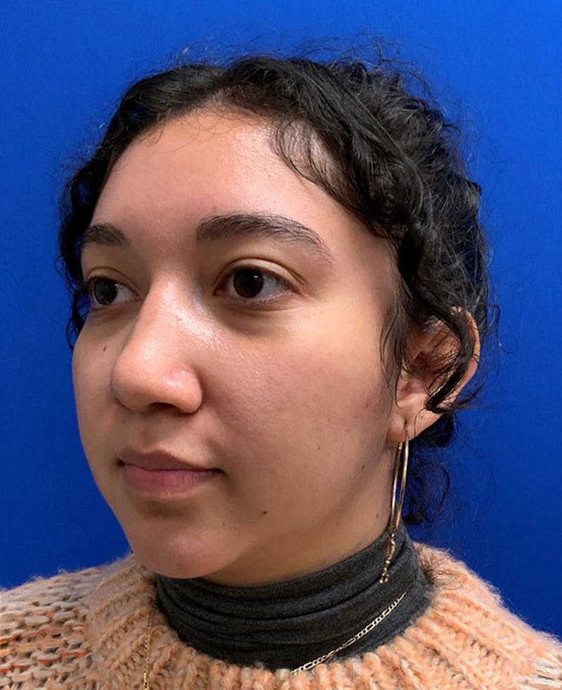 Nose Before & After Gallery - Patient 189960794 - Image 8