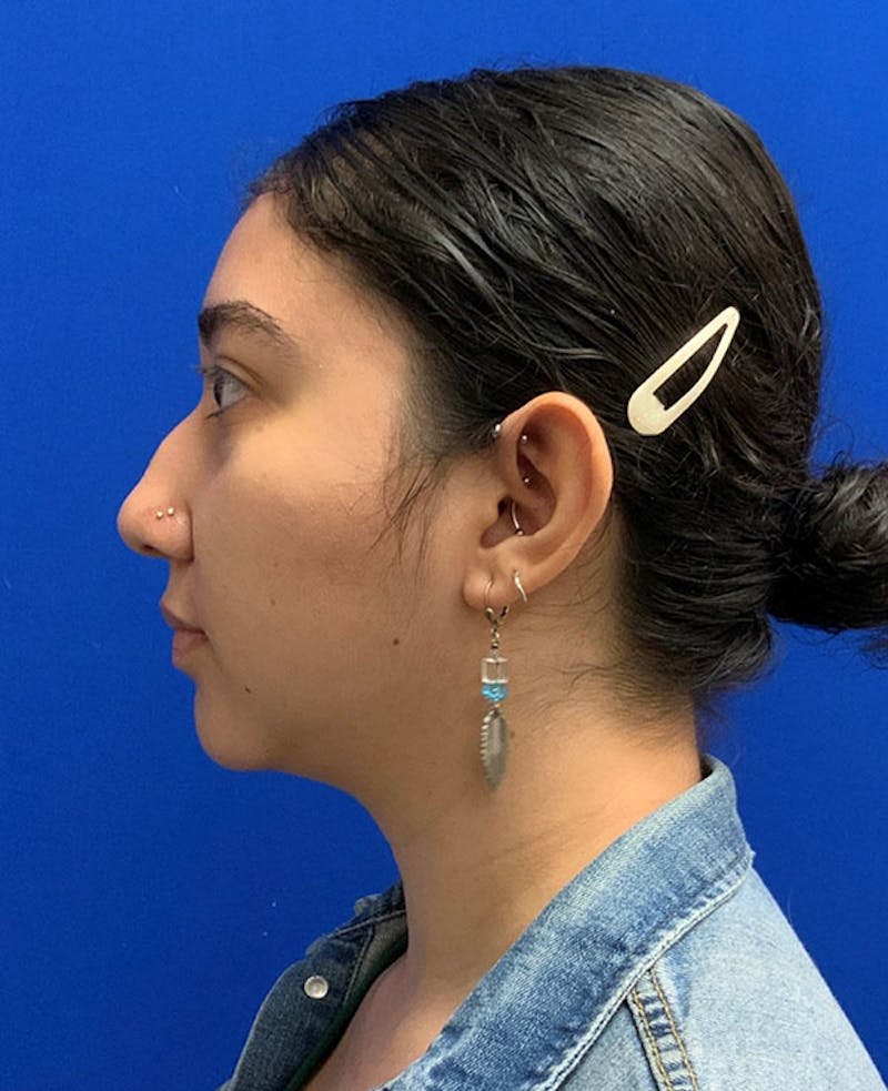 Nose Before & After Gallery - Patient 189960794 - Image 9