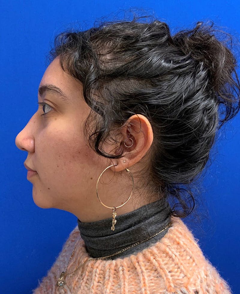 Nose Before & After Gallery - Patient 189960794 - Image 10