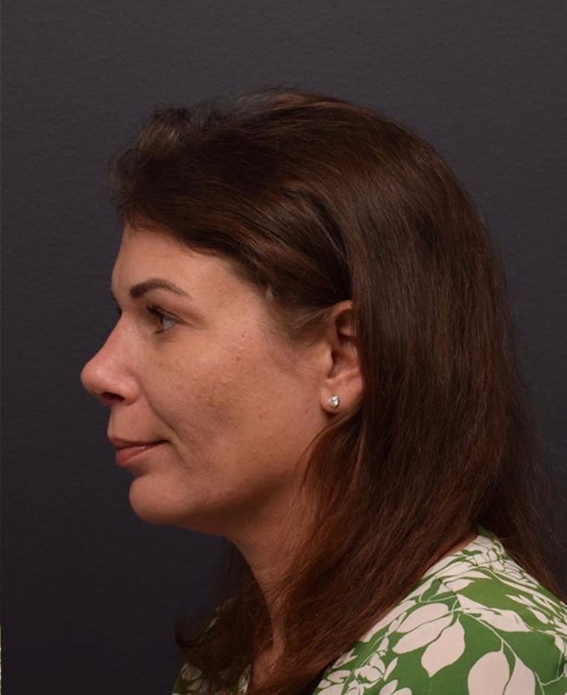 Nose Before & After Gallery - Patient 189960796 - Image 2