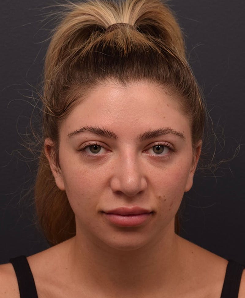 Nose Before & After Gallery - Patient 189960834 - Image 3