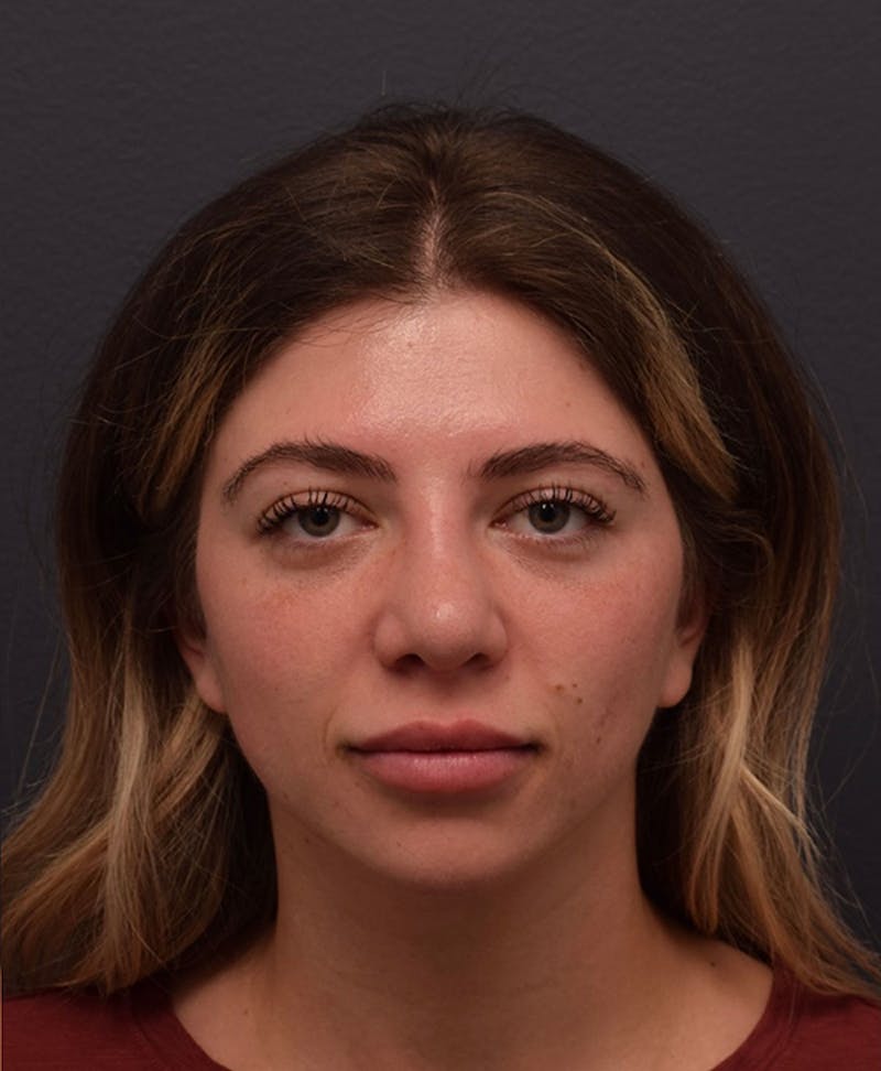Nose Before & After Gallery - Patient 189960834 - Image 4