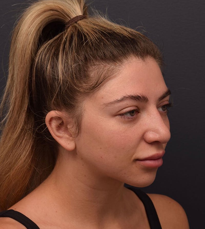 Nose Before & After Gallery - Patient 189960834 - Image 5