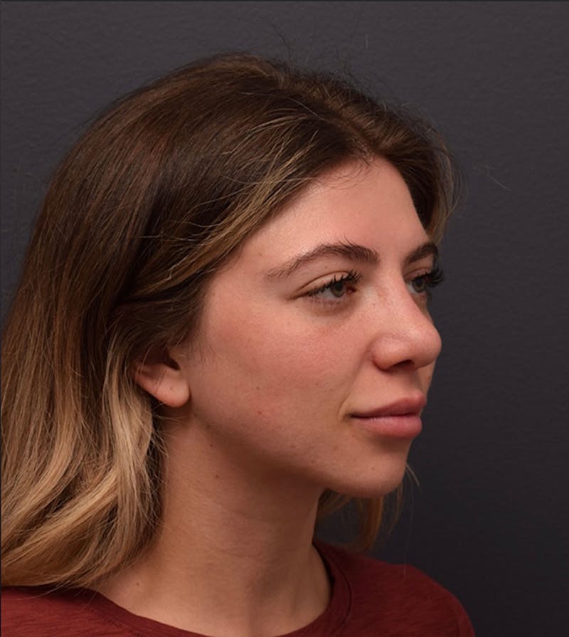 Nose Before & After Gallery - Patient 189960834 - Image 6