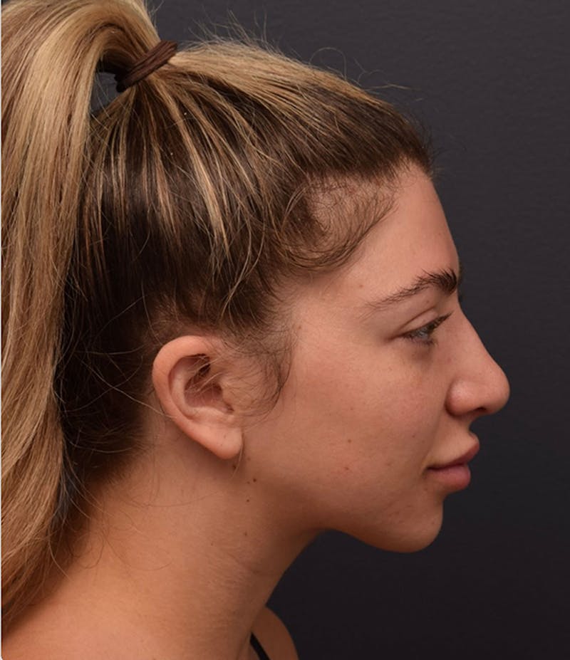 Nose Before & After Gallery - Patient 189960834 - Image 1