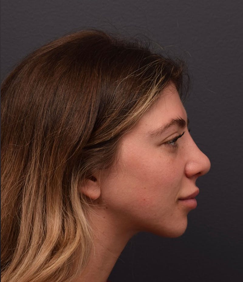 Nose Before & After Gallery - Patient 189960834 - Image 2