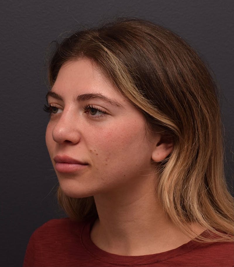 Nose Before & After Gallery - Patient 189960834 - Image 8