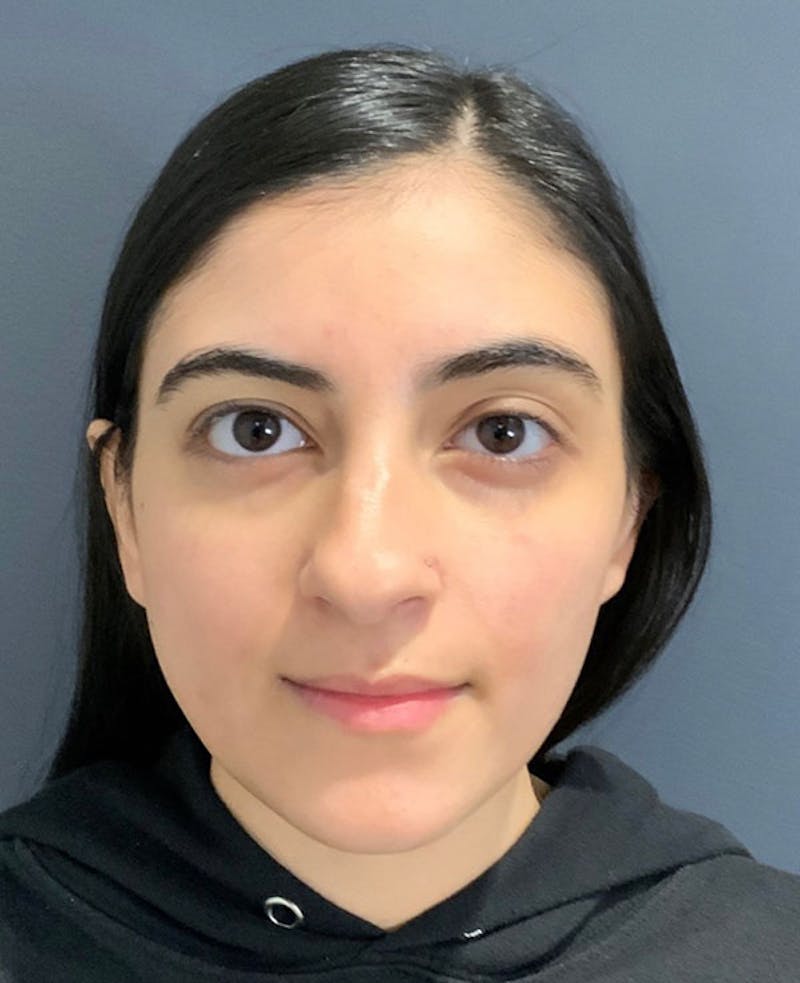 Nose Before & After Gallery - Patient 189960838 - Image 3