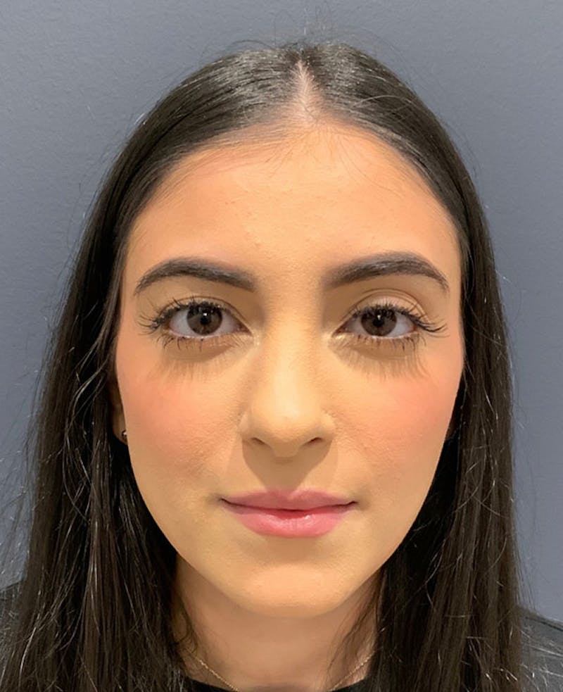Nose Before & After Gallery - Patient 189960838 - Image 4