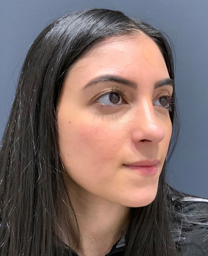 Nose Before & After Gallery - Patient 189960838 - Image 6