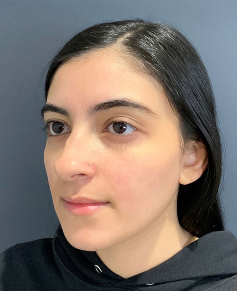 Nose Before & After Gallery - Patient 189960838 - Image 7