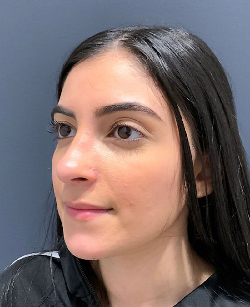 Nose Before & After Gallery - Patient 189960838 - Image 8
