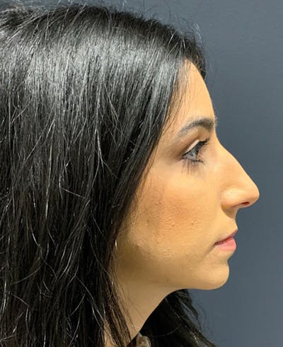 Nose Before & After Gallery - Patient 189960840 - Image 1