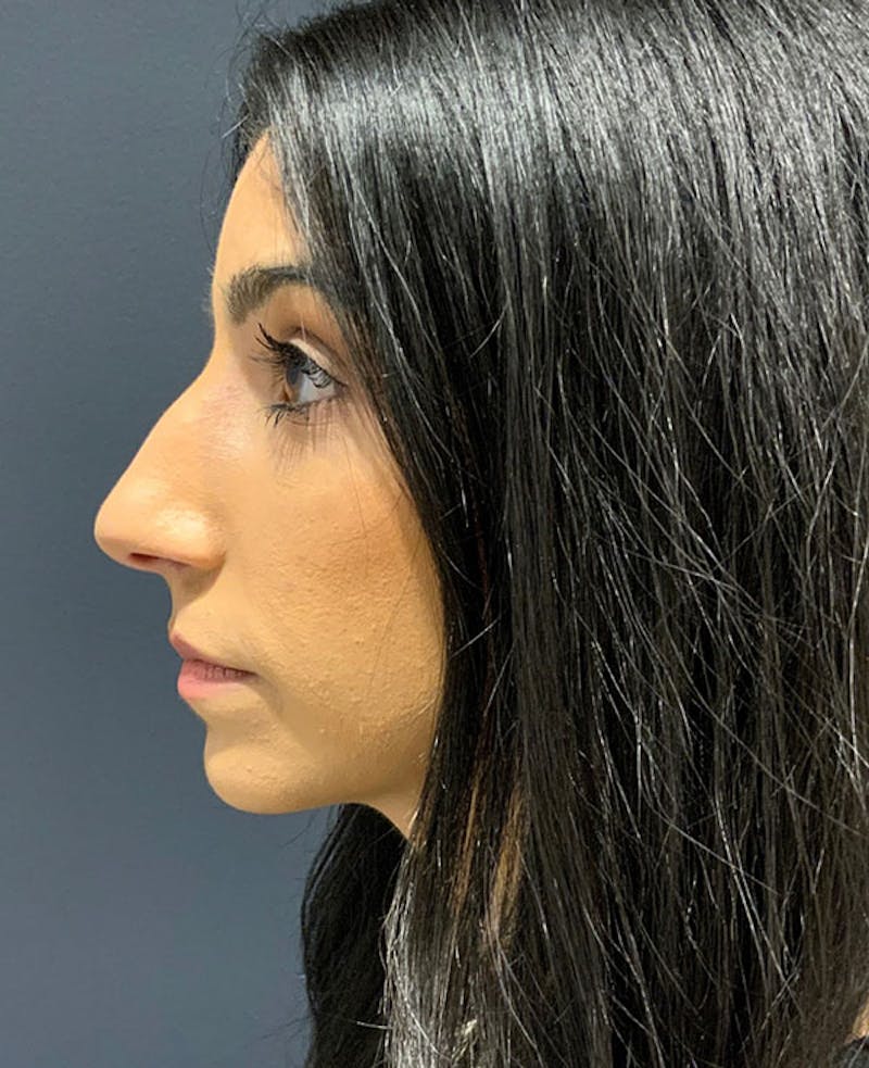 Nose Before & After Gallery - Patient 189960840 - Image 9