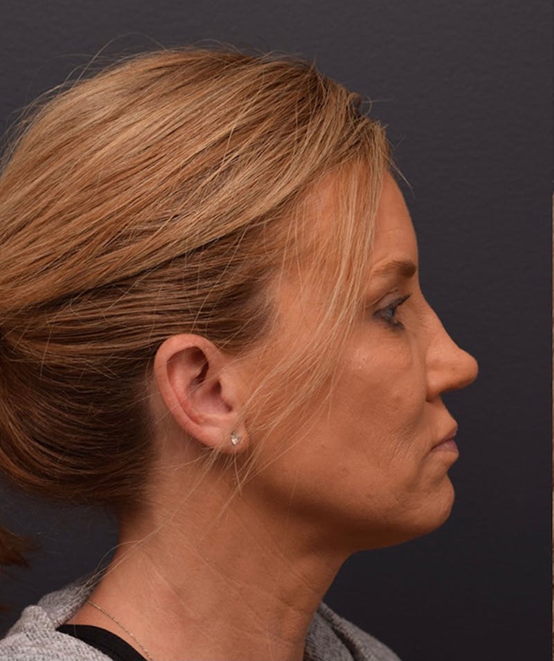 Nose Before & After Gallery - Patient 189960853 - Image 1