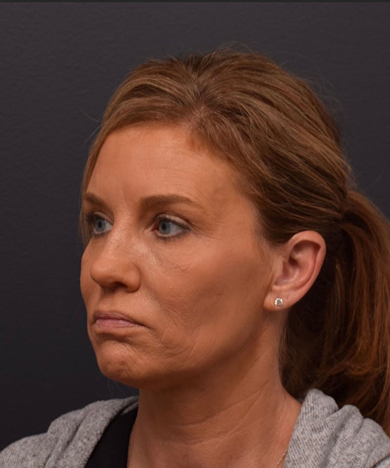 Nose Before & After Gallery - Patient 189960853 - Image 7