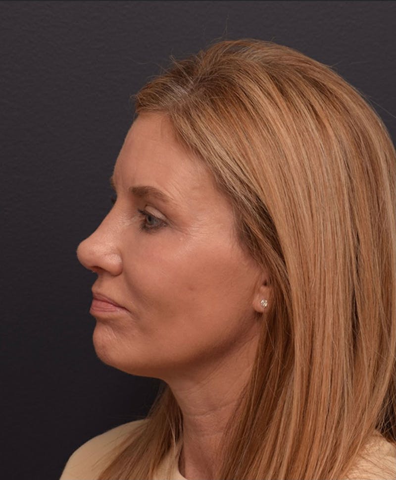 Nose Before & After Gallery - Patient 189960853 - Image 10