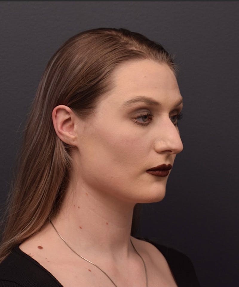 Nose Before & After Gallery - Patient 189960855 - Image 3