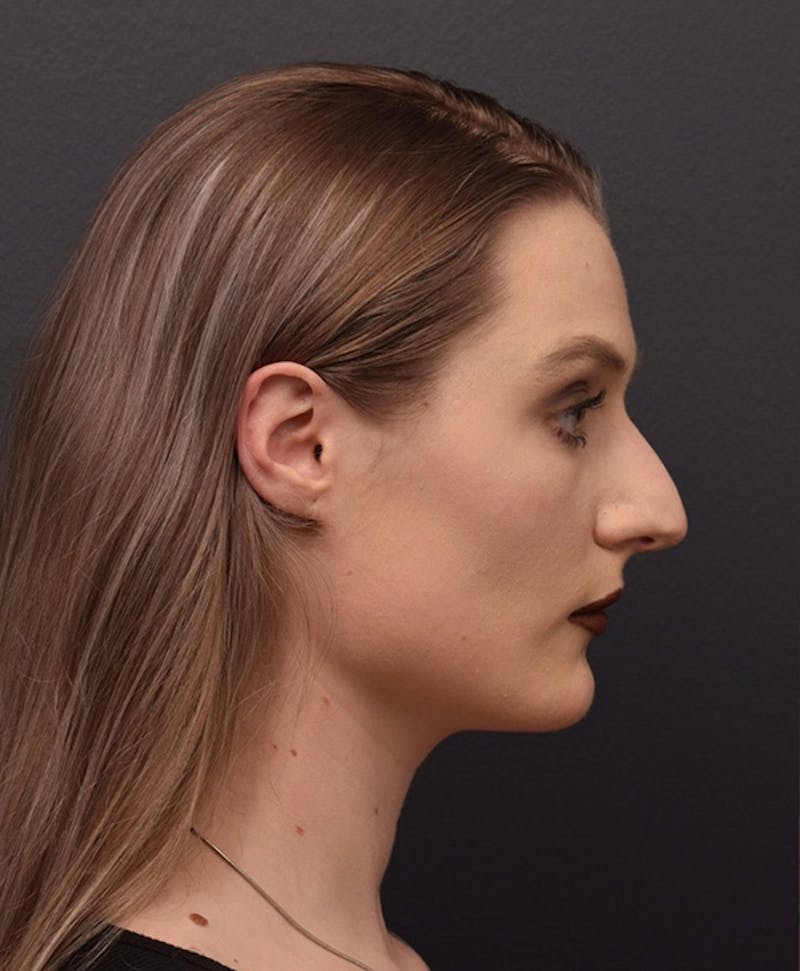 Nose Before & After Gallery - Patient 189960855 - Image 1