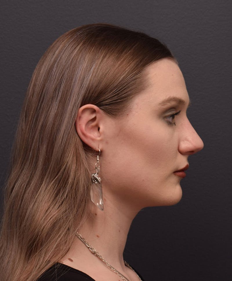 Nose Before & After Gallery - Patient 189960855 - Image 2