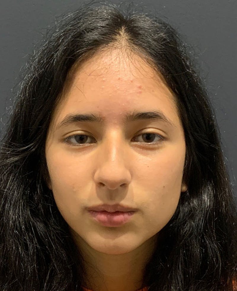 Nose Before & After Gallery - Patient 189960858 - Image 3