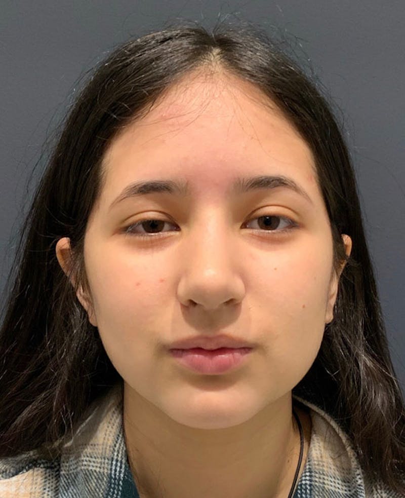 Nose Before & After Gallery - Patient 189960858 - Image 4
