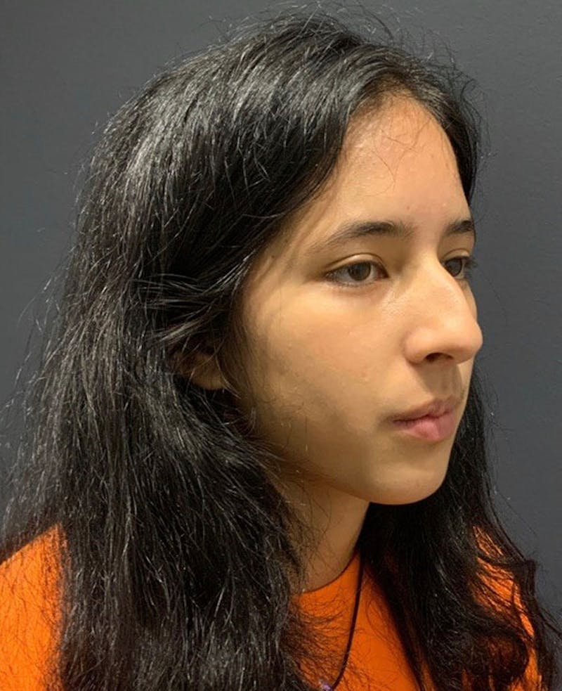 Nose Before & After Gallery - Patient 189960858 - Image 5