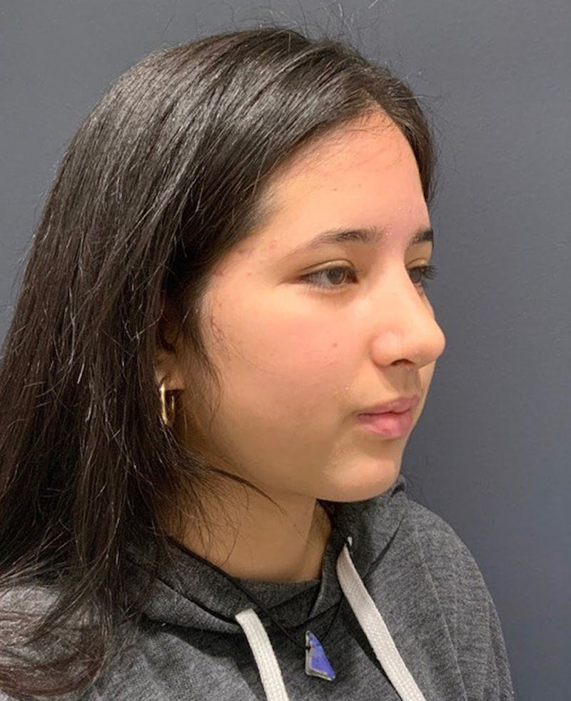 Nose Before & After Gallery - Patient 189960858 - Image 6