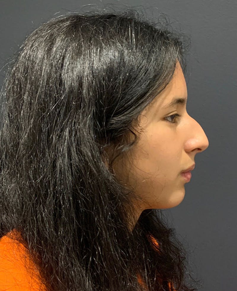 Nose Before & After Gallery - Patient 189960858 - Image 1