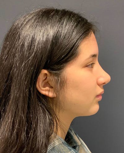 Nose Before & After Gallery - Patient 189960858 - Image 2