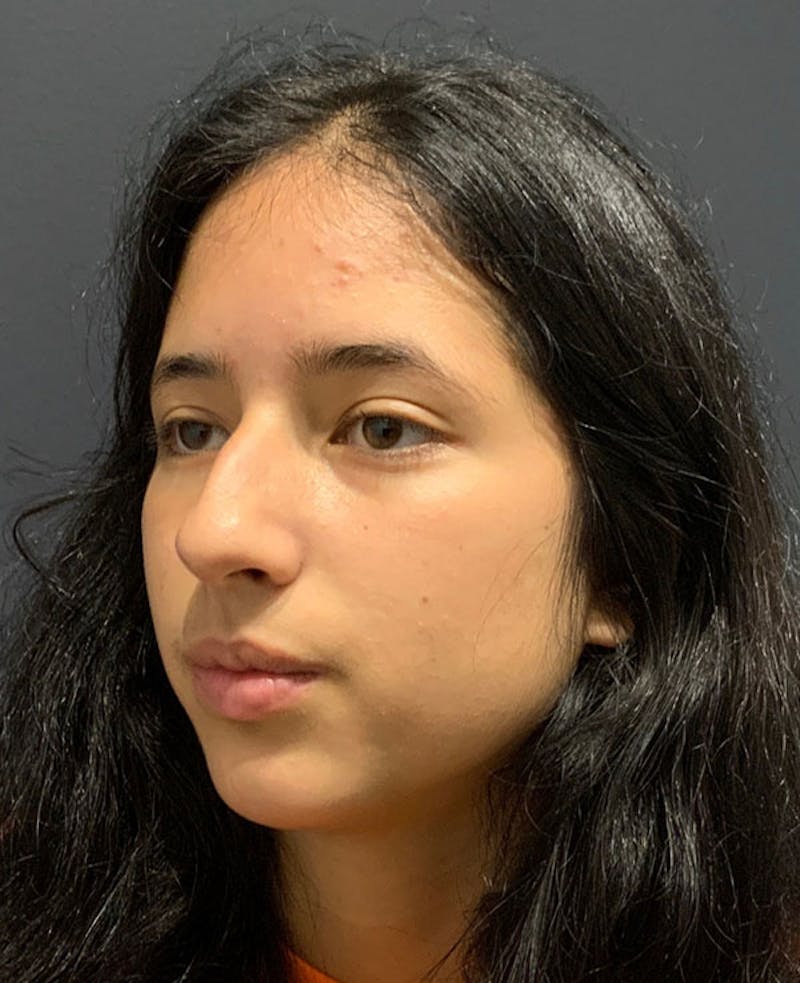Nose Before & After Gallery - Patient 189960858 - Image 7