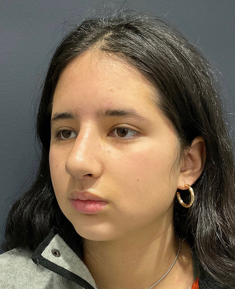 Nose Before & After Gallery - Patient 189960858 - Image 8