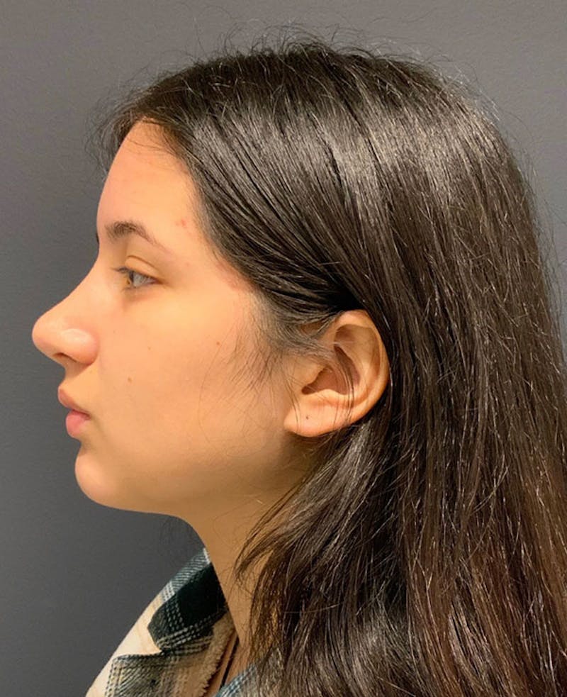 Nose Before & After Gallery - Patient 189960858 - Image 10