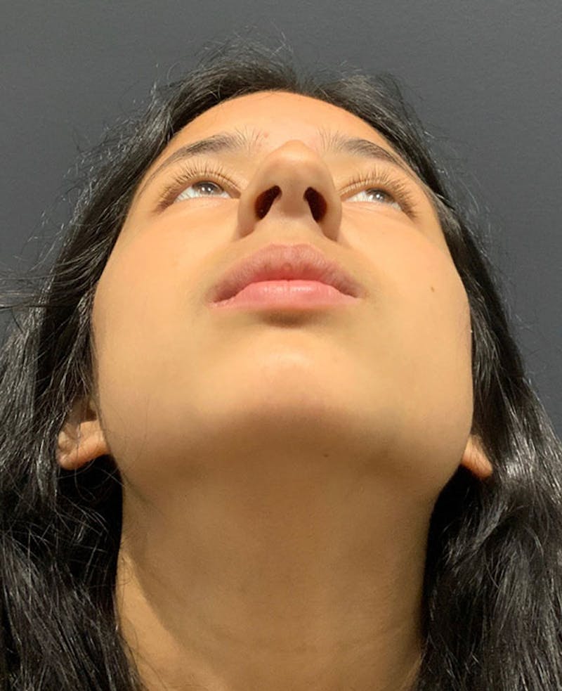 Nose Before & After Gallery - Patient 189960858 - Image 11