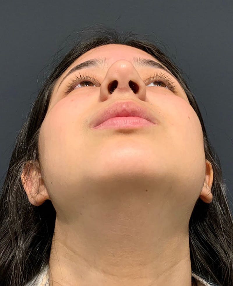 Nose Before & After Gallery - Patient 189960858 - Image 12