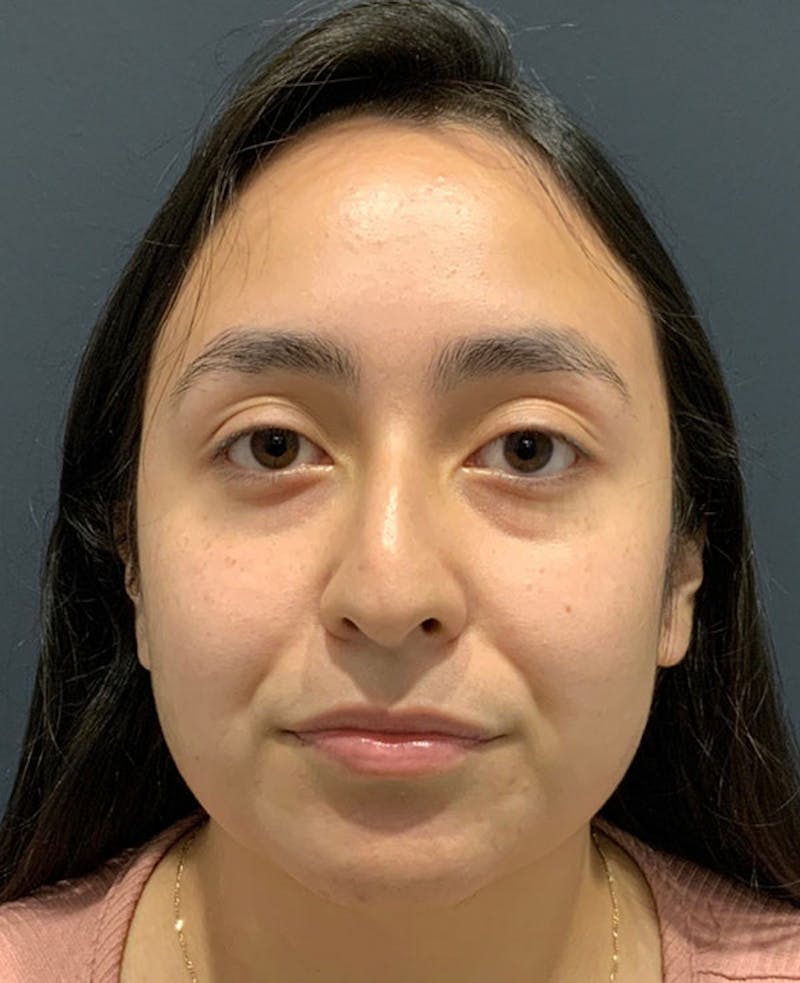 Nose Before & After Gallery - Patient 189960886 - Image 3