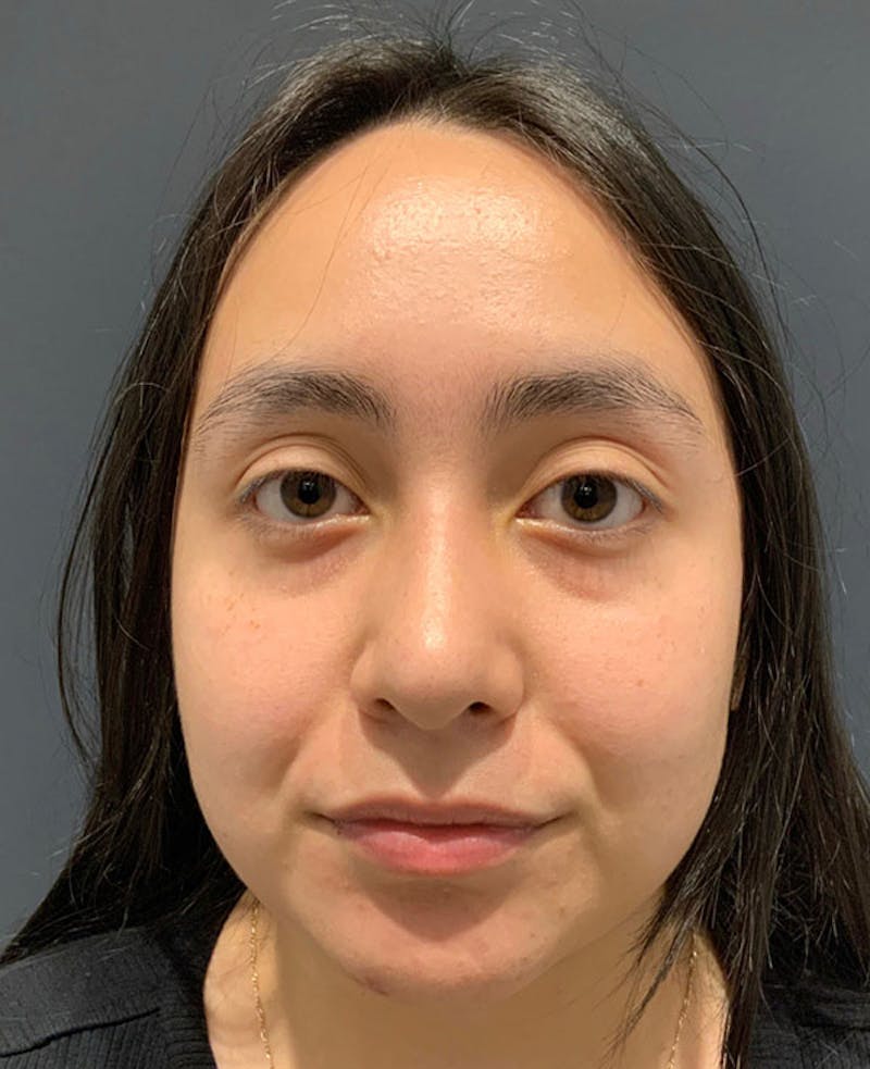Nose Before & After Gallery - Patient 189960886 - Image 4