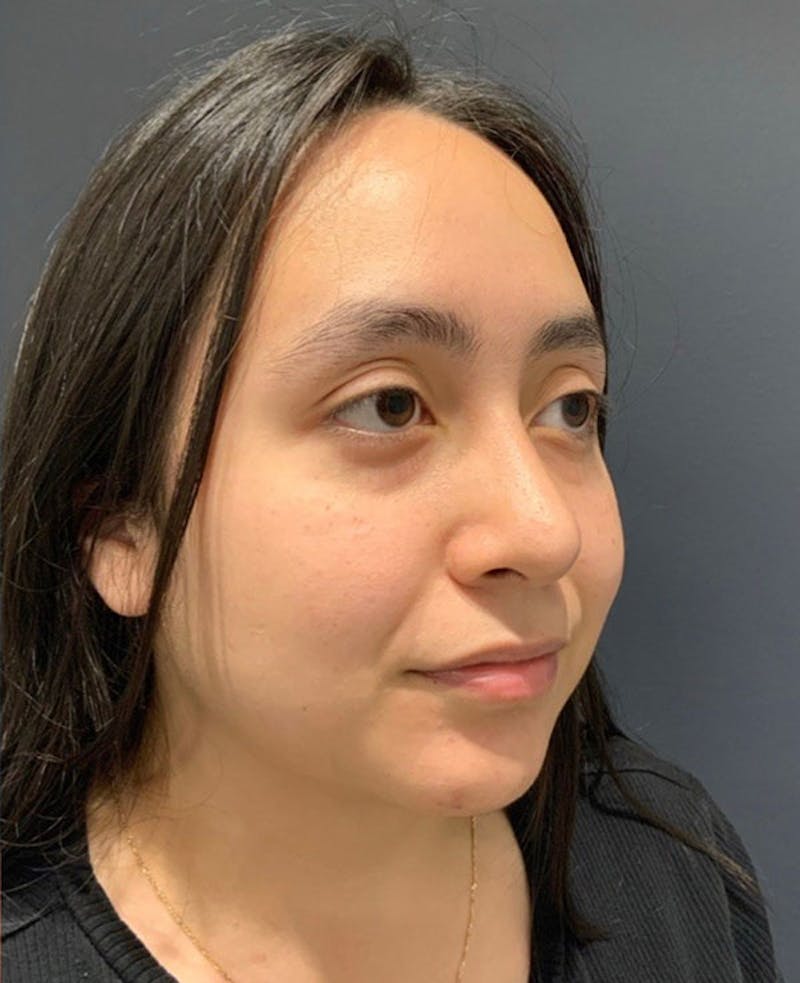 Nose Before & After Gallery - Patient 189960886 - Image 6