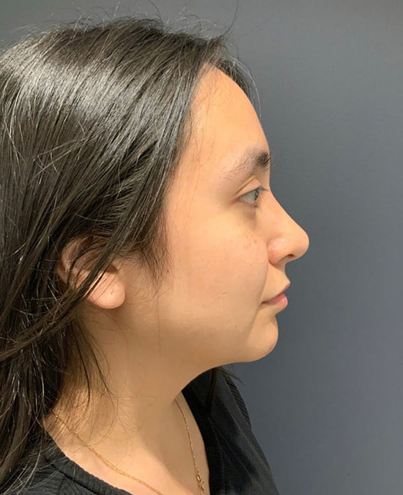 Nose Before & After Gallery - Patient 189960886 - Image 2