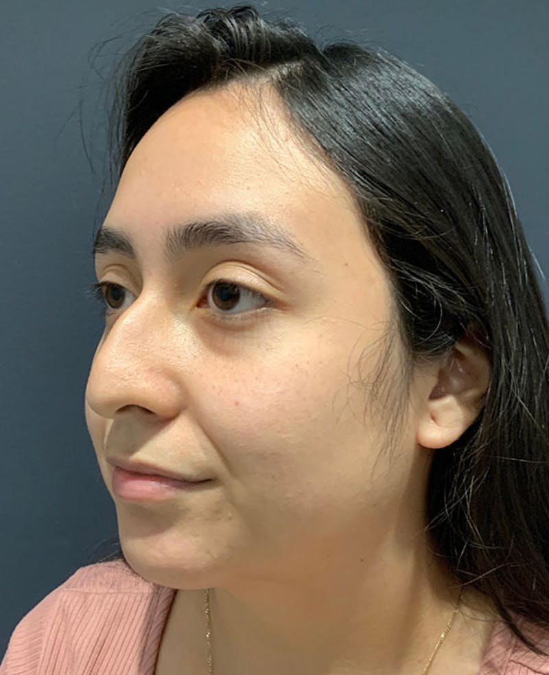Nose Before & After Gallery - Patient 189960886 - Image 7