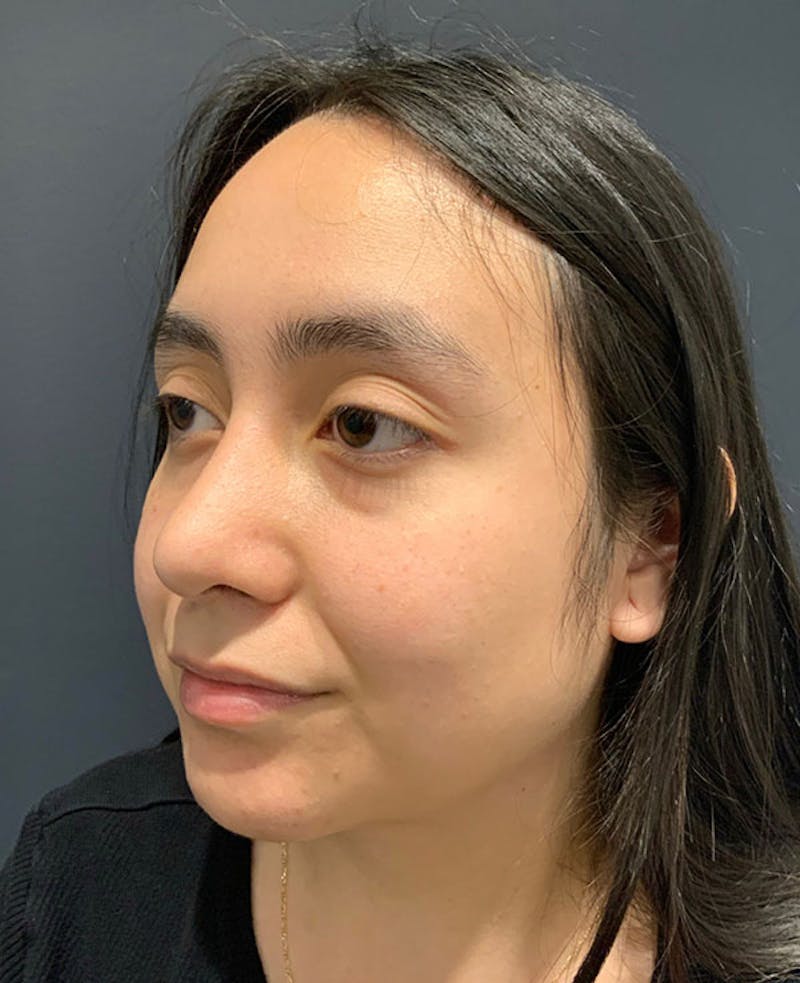 Nose Before & After Gallery - Patient 189960886 - Image 8